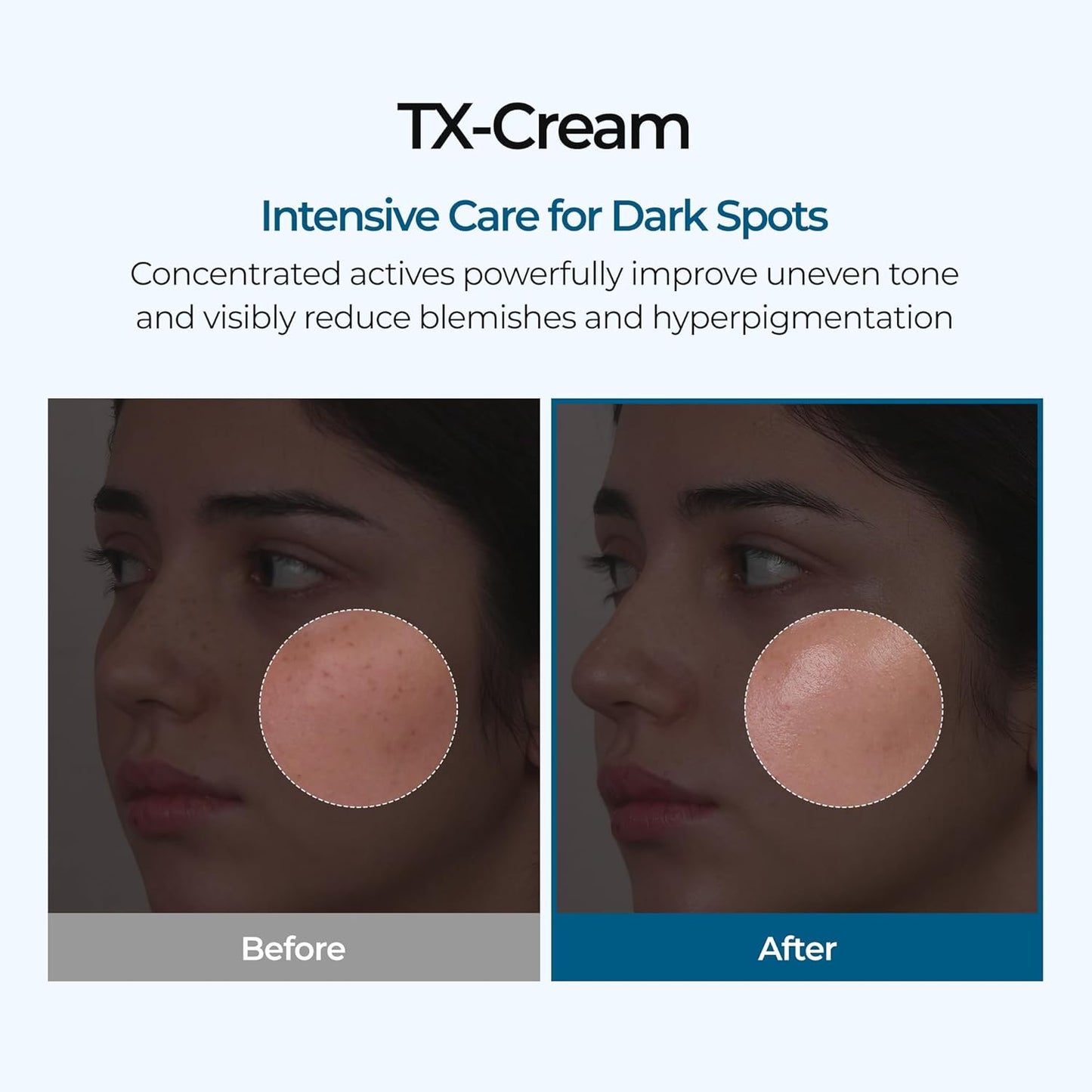 Tx Tranexamic Acid Cream Skin Freckle Cream, Blemishes, Anti-Pigmetation Korean Skin Care Korean Cosmetics 1.69 Fl Oz (50Ml) White